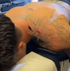Camelback Medical Centers | The Benefits of Dry Needling
